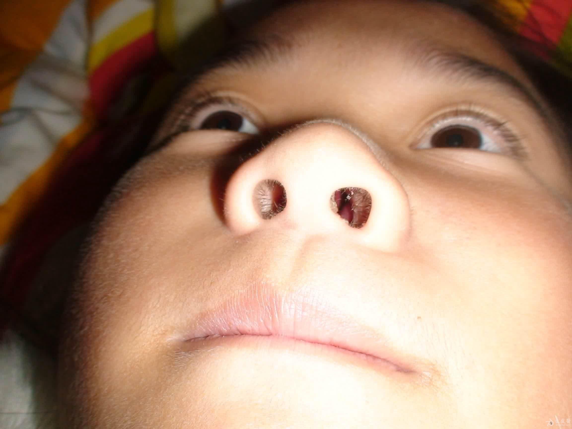 儿童鼻息肉 初期图片