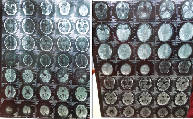请懂得看颅脑b超与核磁共振胶片的老师帮助:30周早产男婴,叶状全前脑