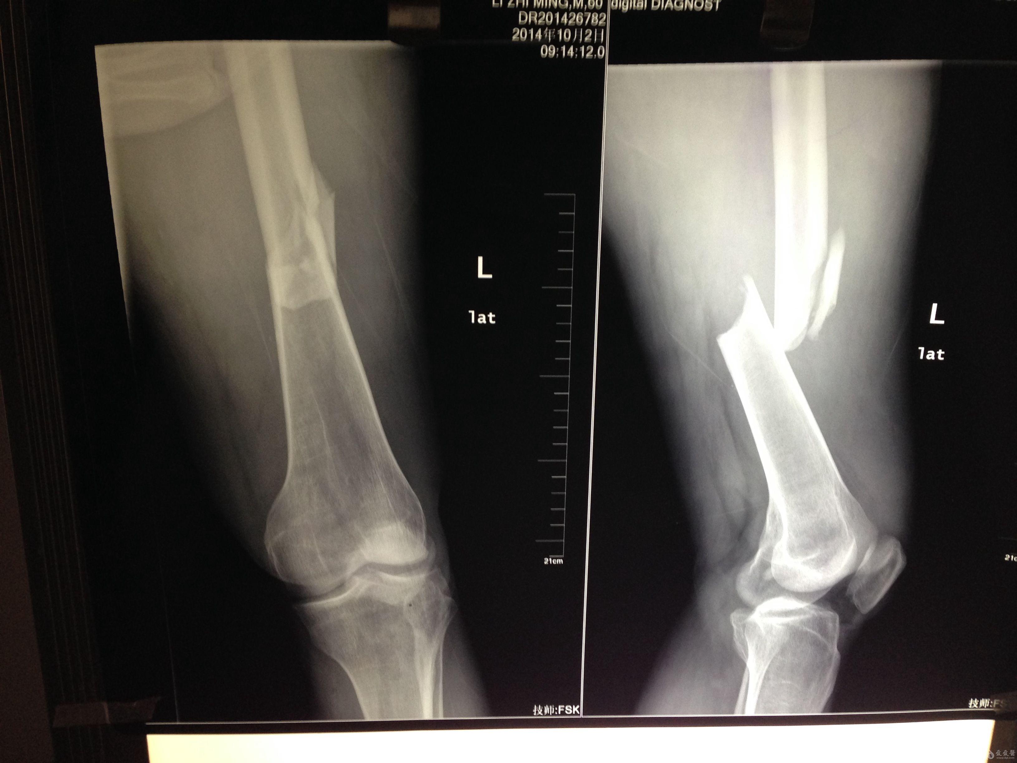 左足股骨图片图片
