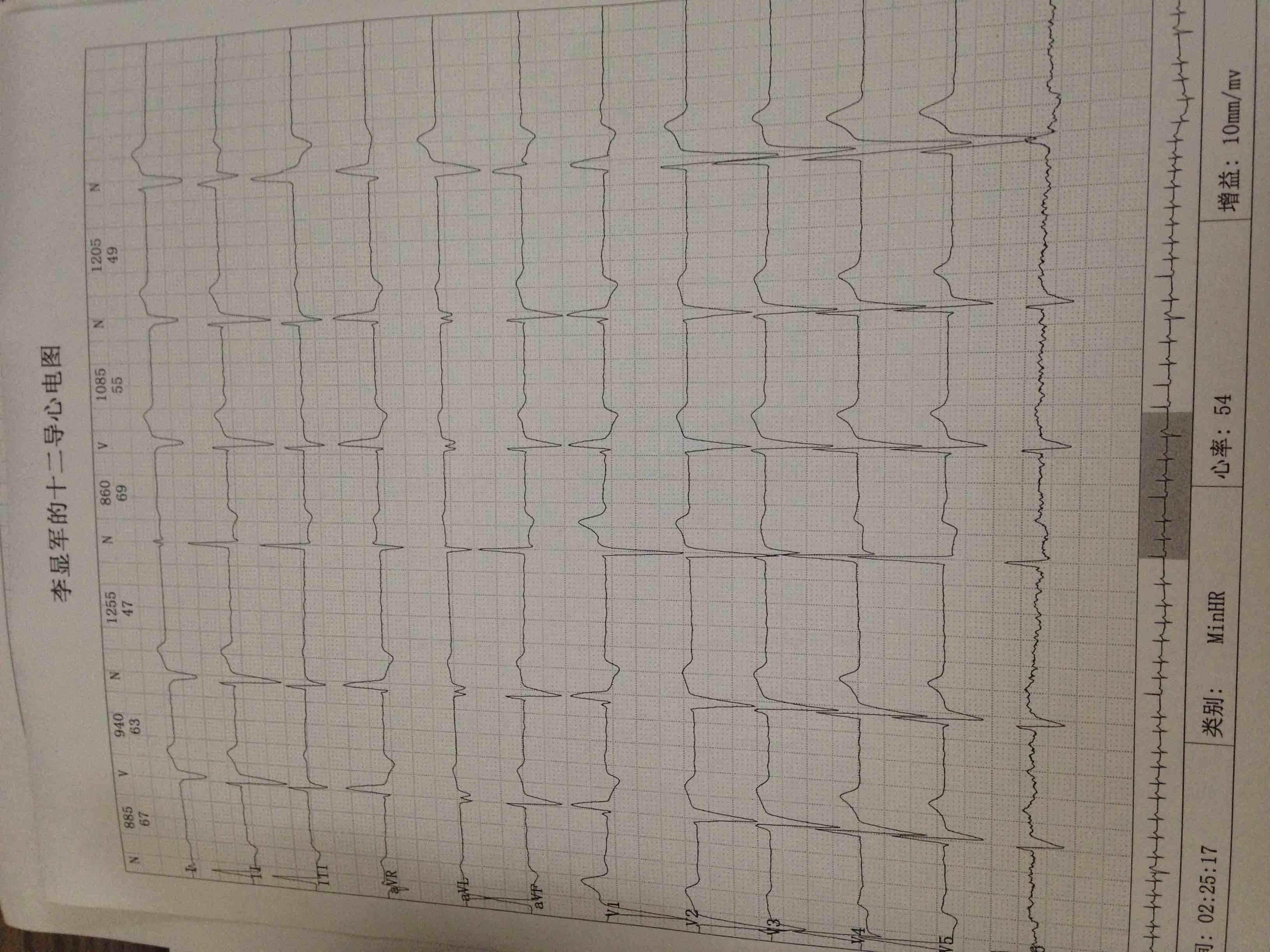 宽qrs波快速型心律失常