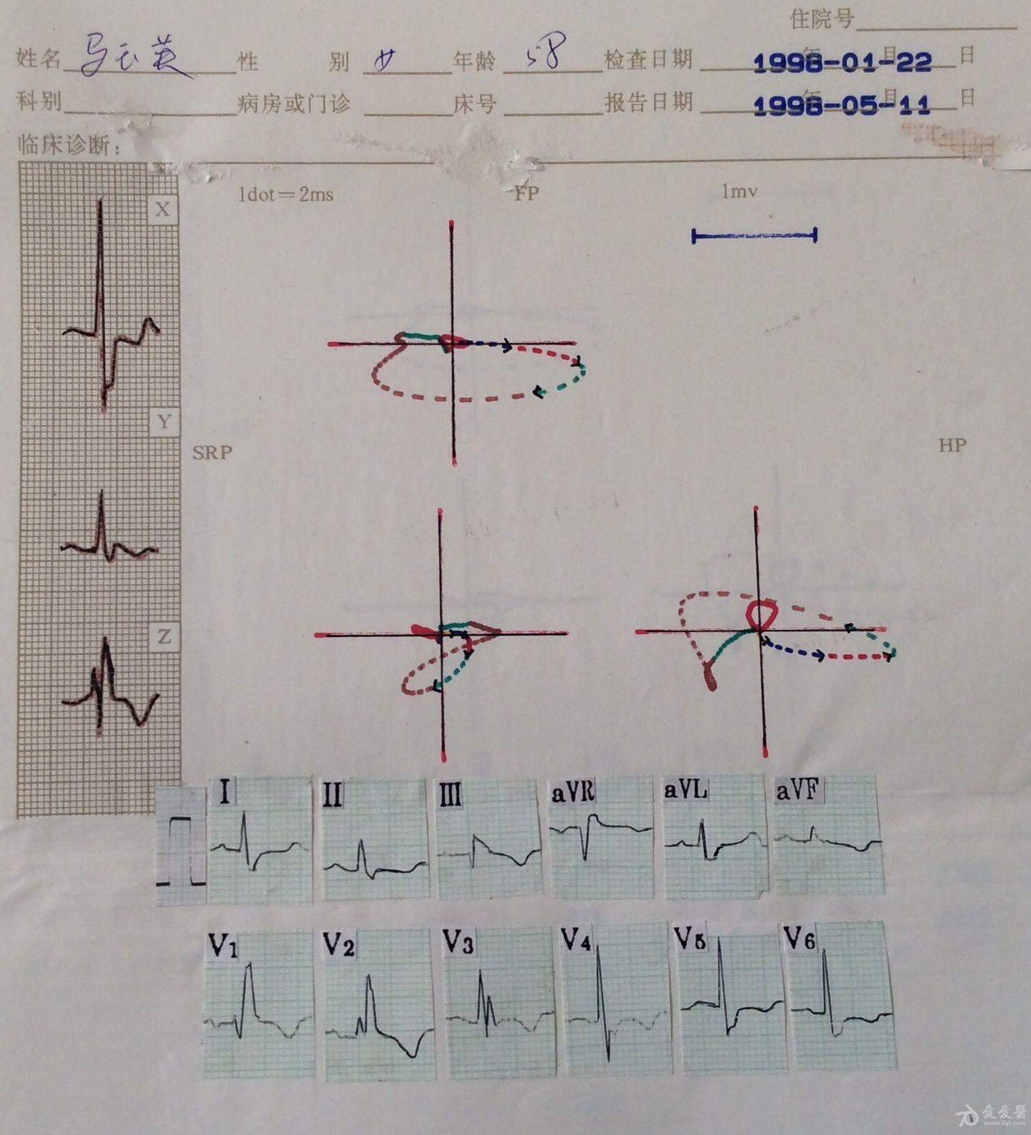 迎新年看心电图熟悉向量图1314束支阻滞