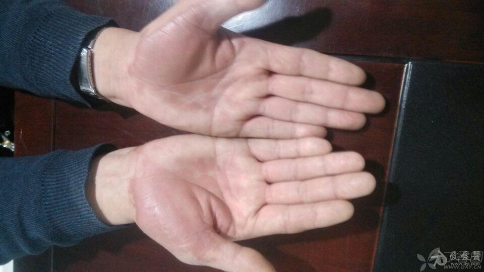 双手掌增厚数年,反复接触水后皮肤发白