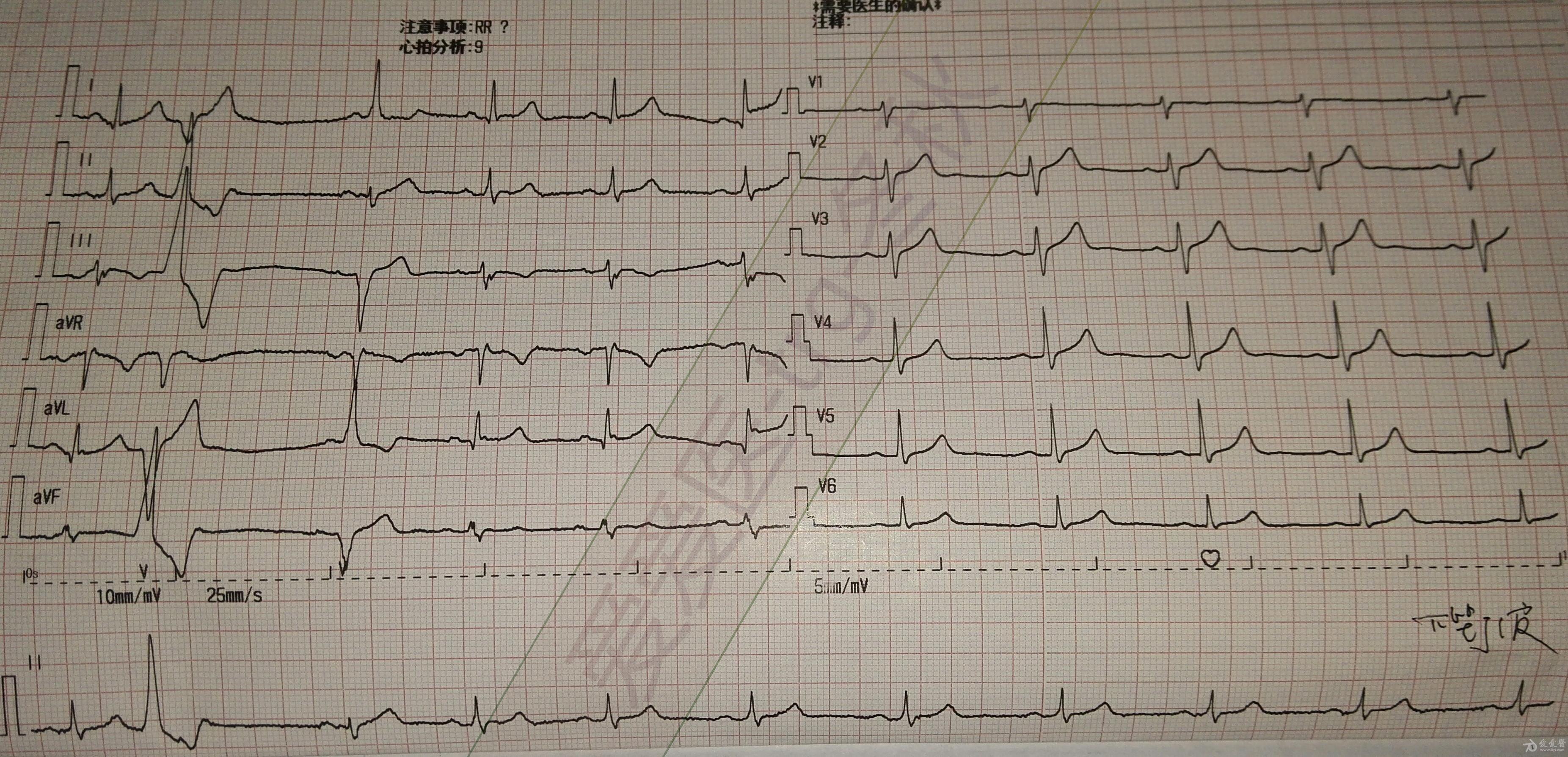qs型心电图图片