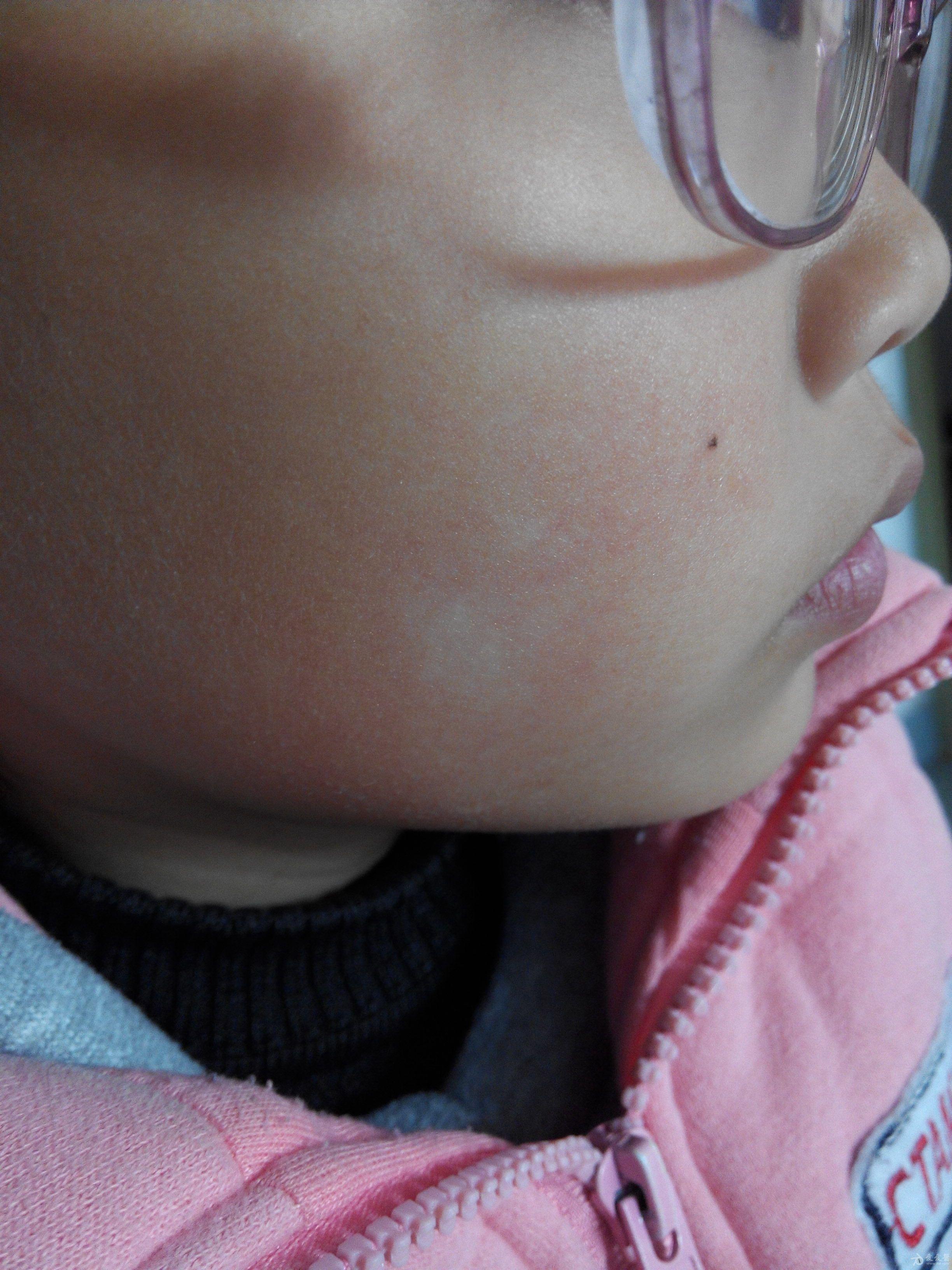 孩子缺锌脸上白斑图片 儿童脸上白斑越来越多