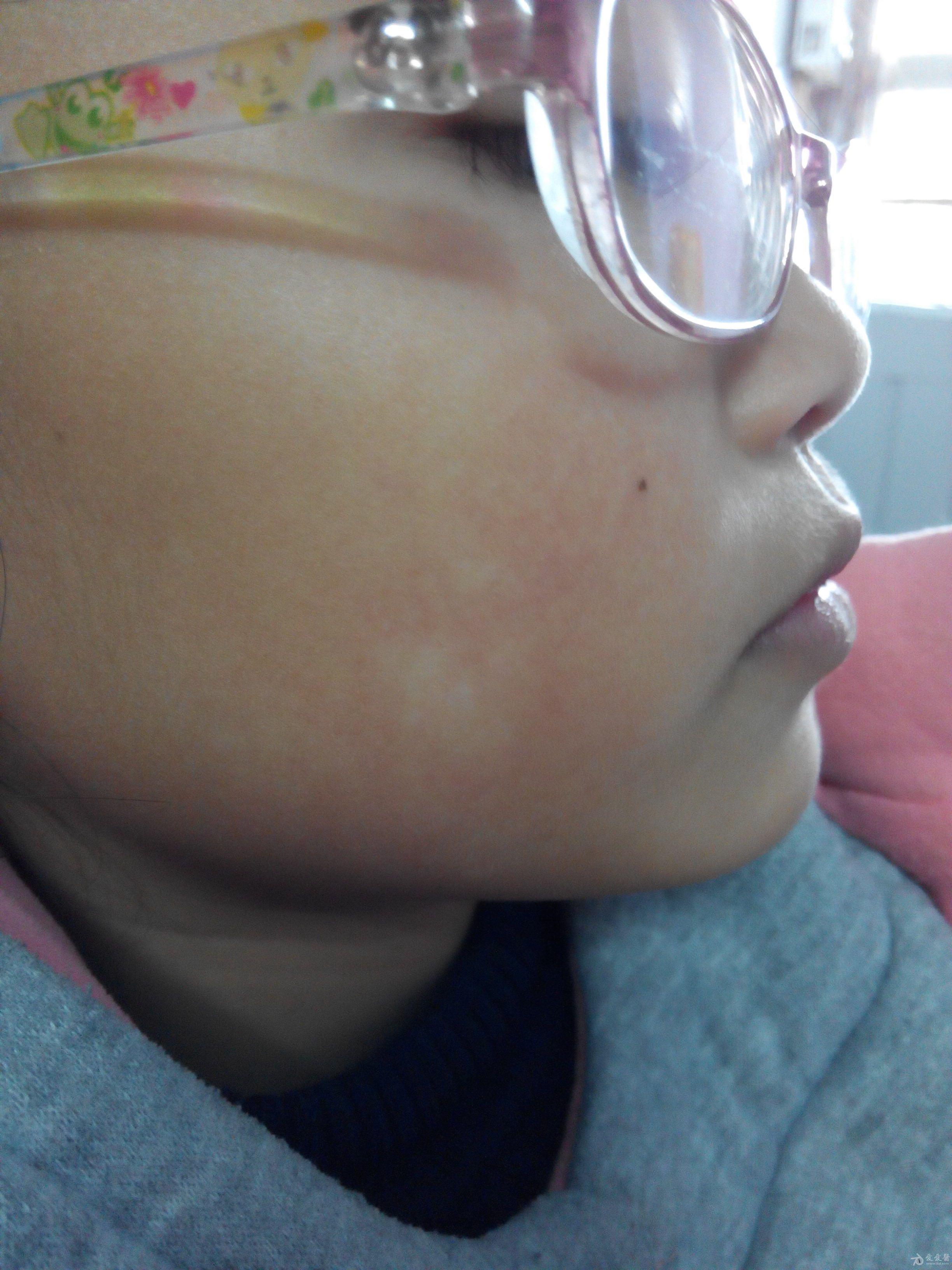 我儿子脸上长了很多小疙瘩，红色疙瘩 ， 白色尖尖。上图，求解答 。_百度知道