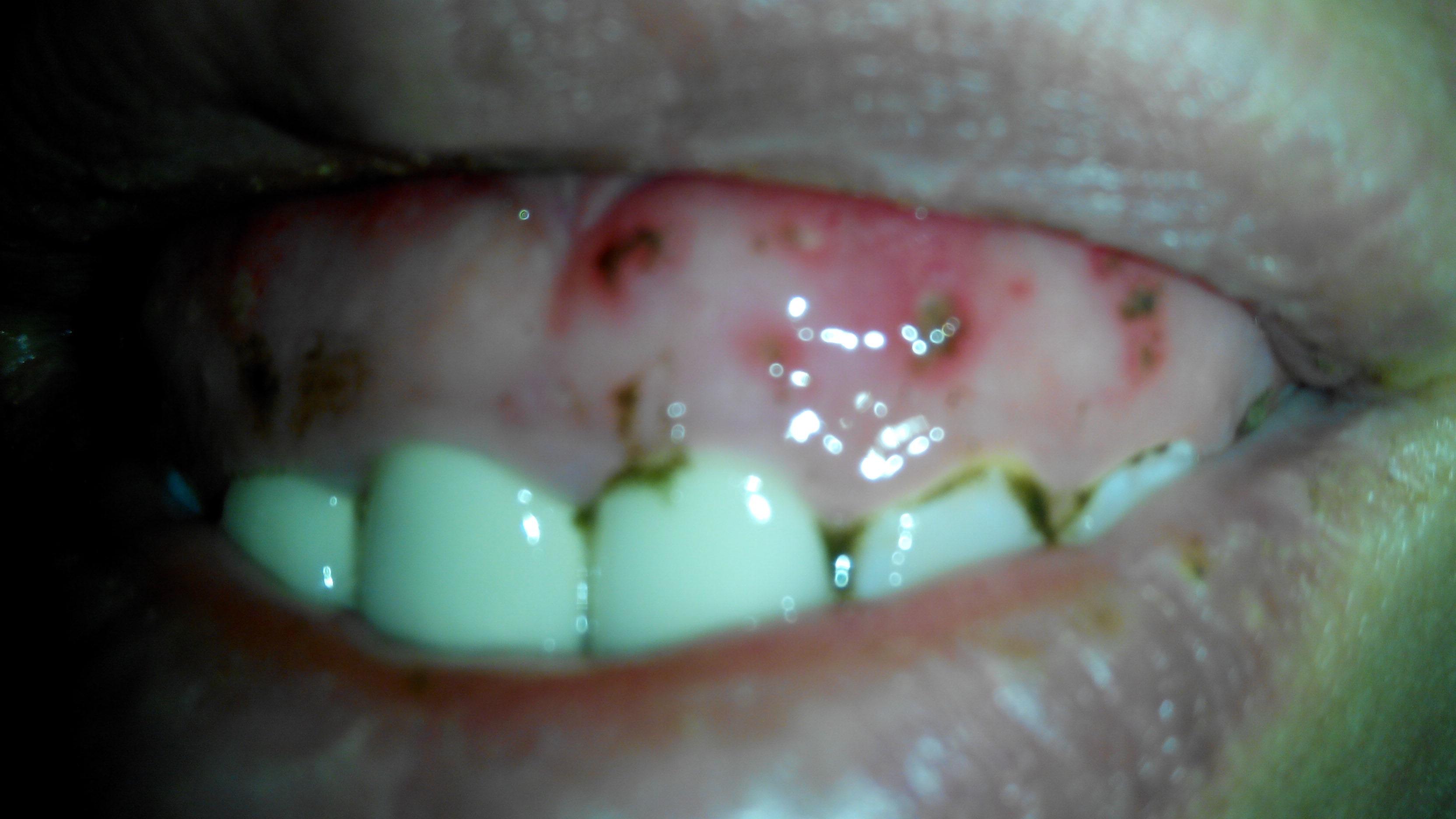 牙龈红斑图片