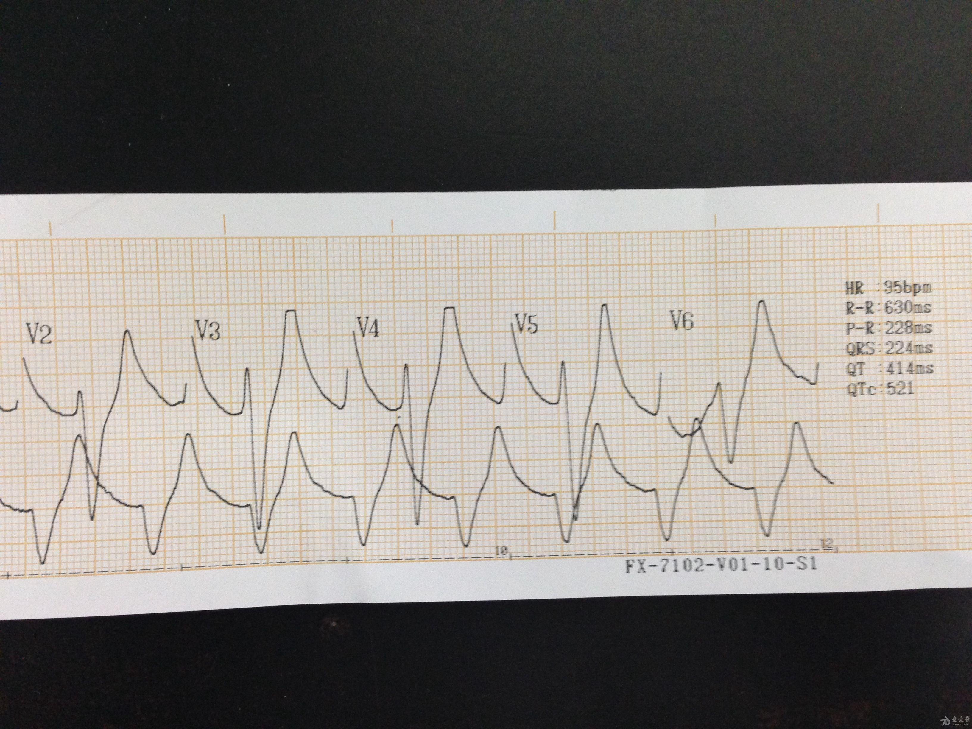 高钾的心电图三个特征图片