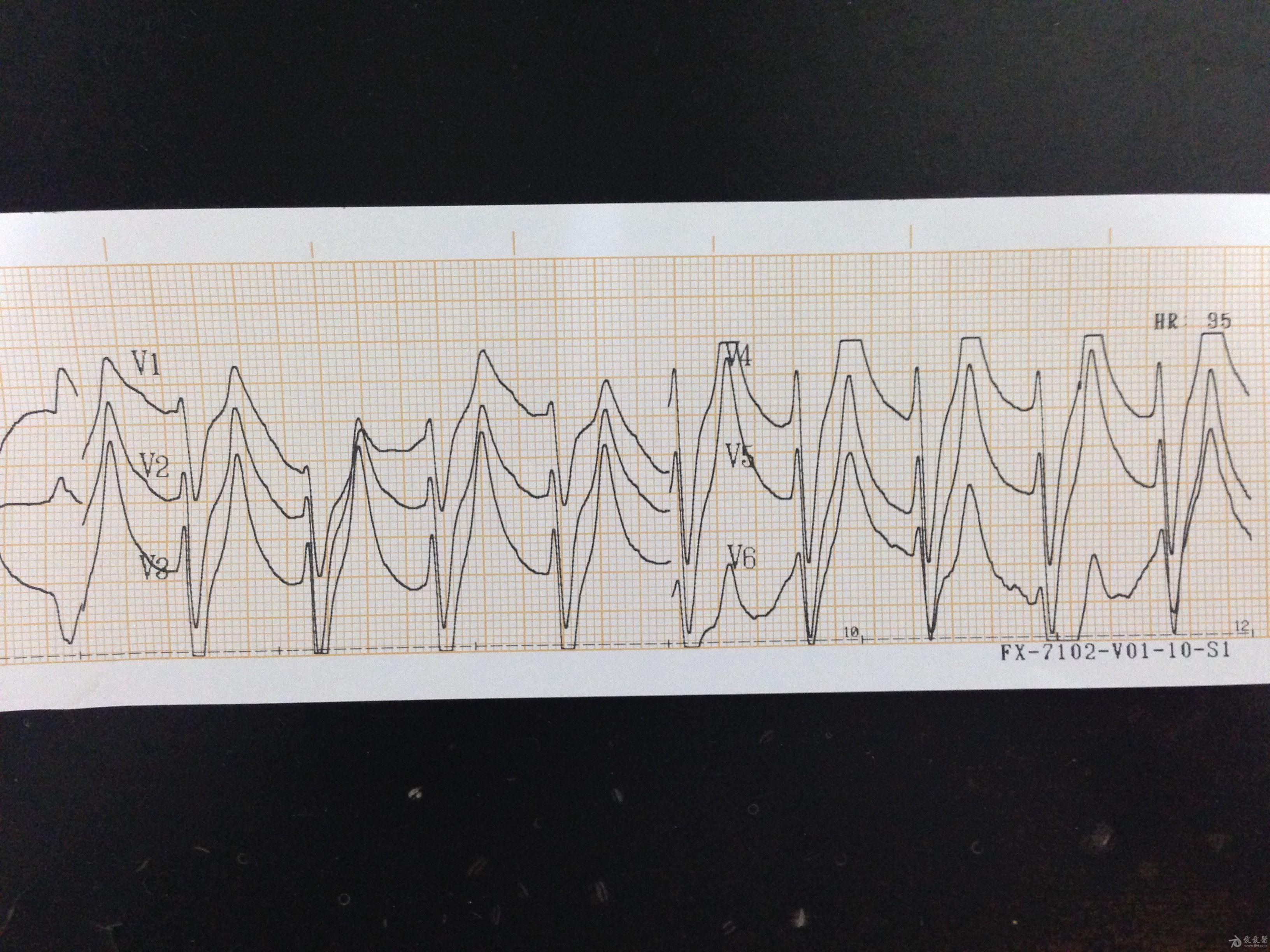 高钾的心电图波形图片图片