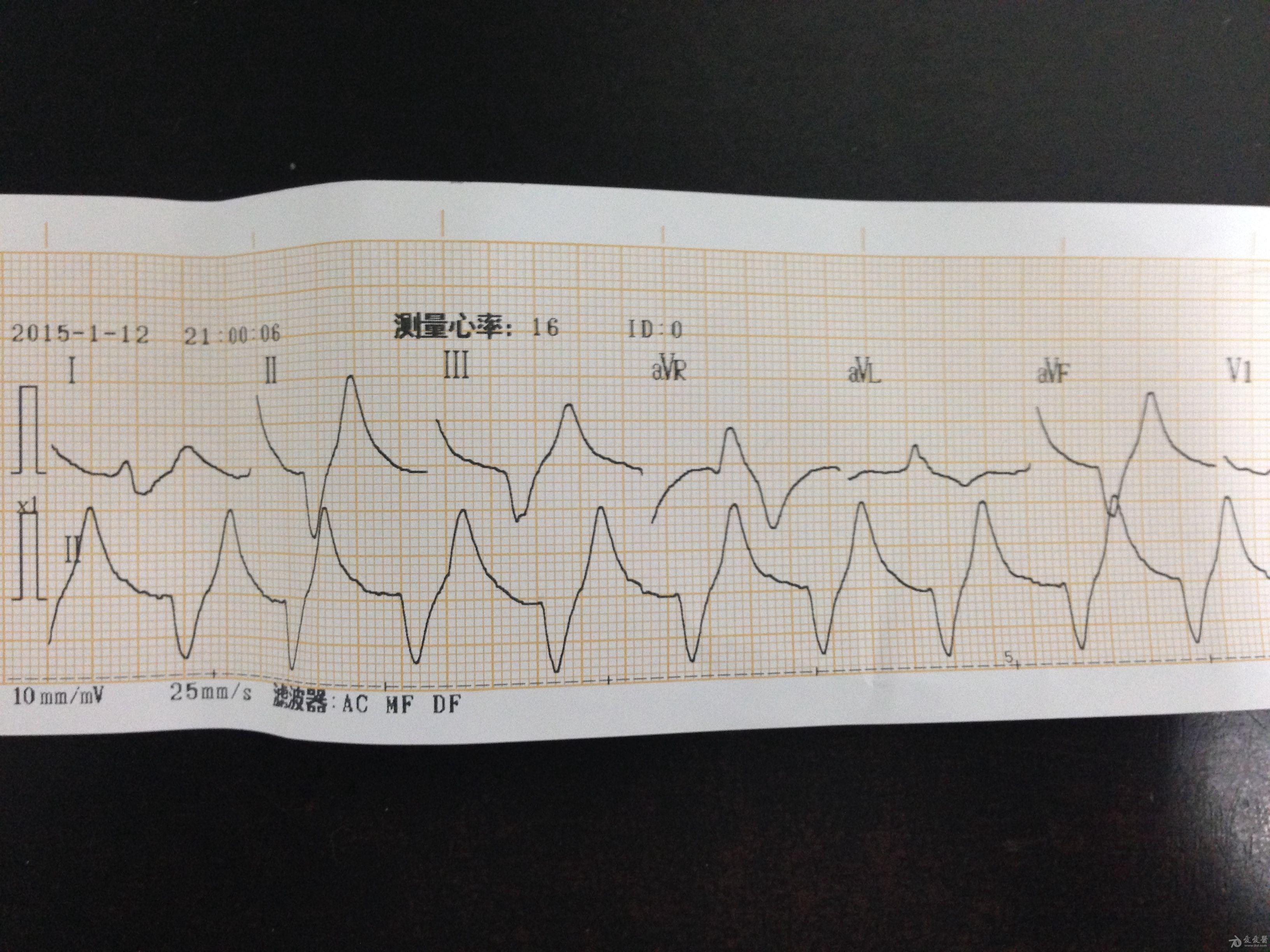 高钾的心电图波形图片图片