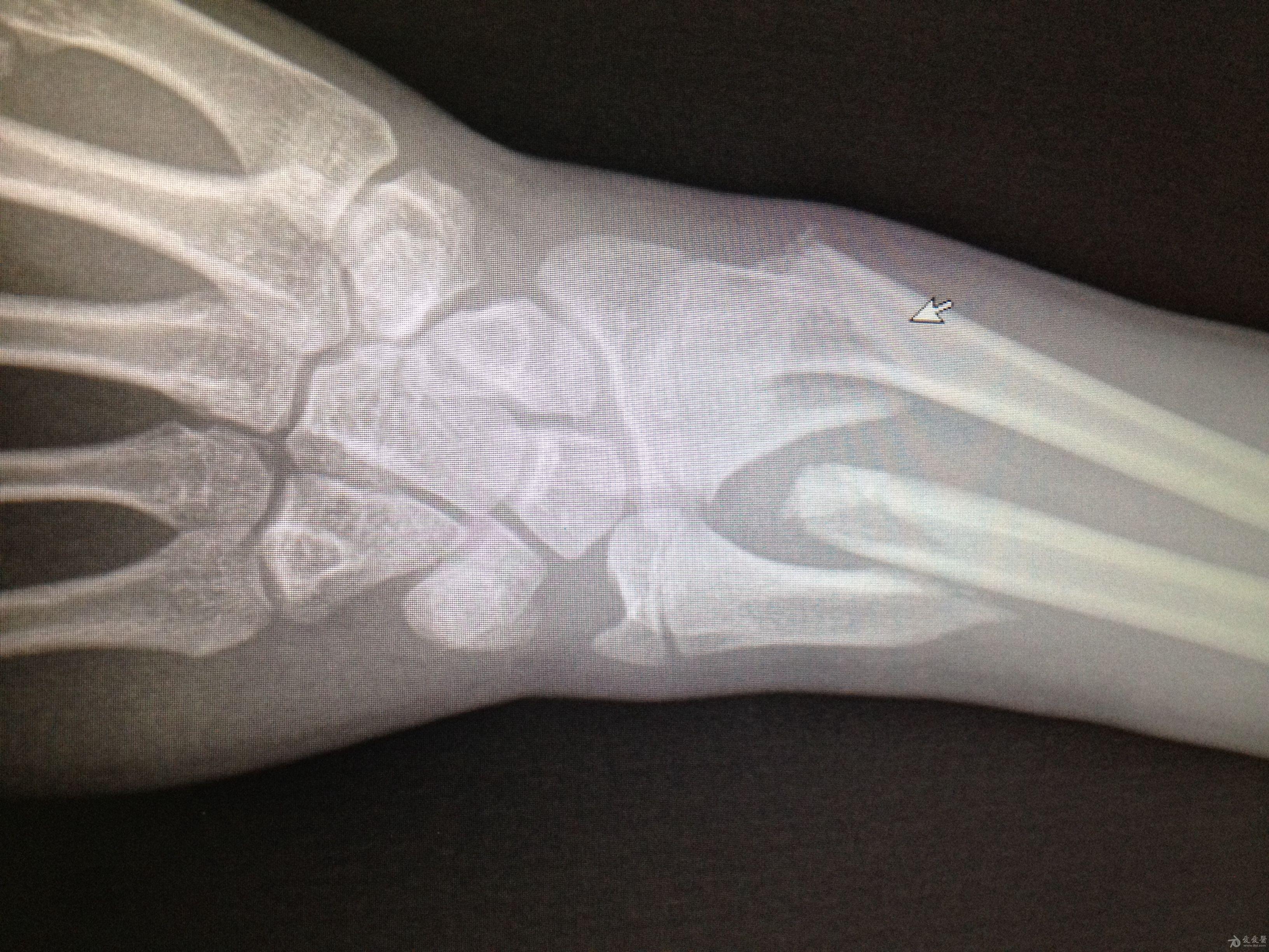 前臂双骨折,请教治疗方案 - 骨科与显微外科专业讨论