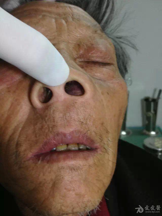 鼻前庭疖肿鼻前庭炎图片