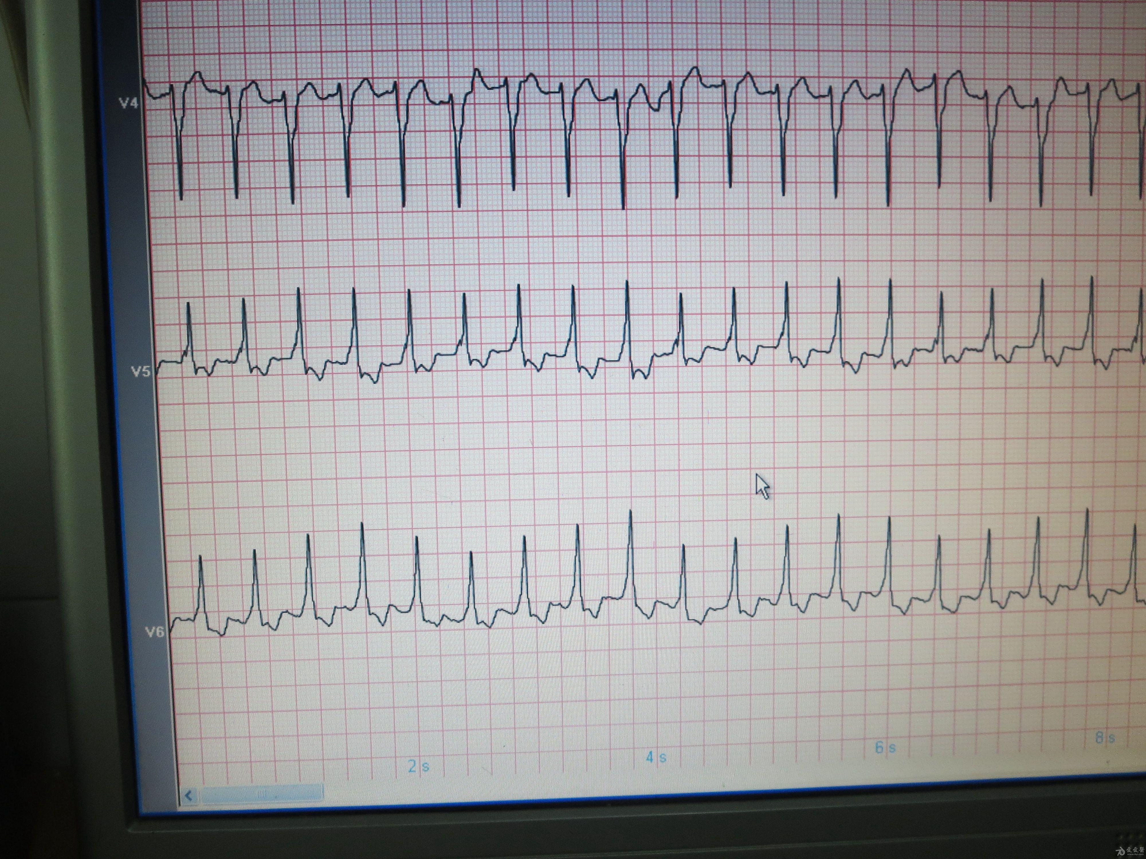 宽大的qrs波的心电图图片