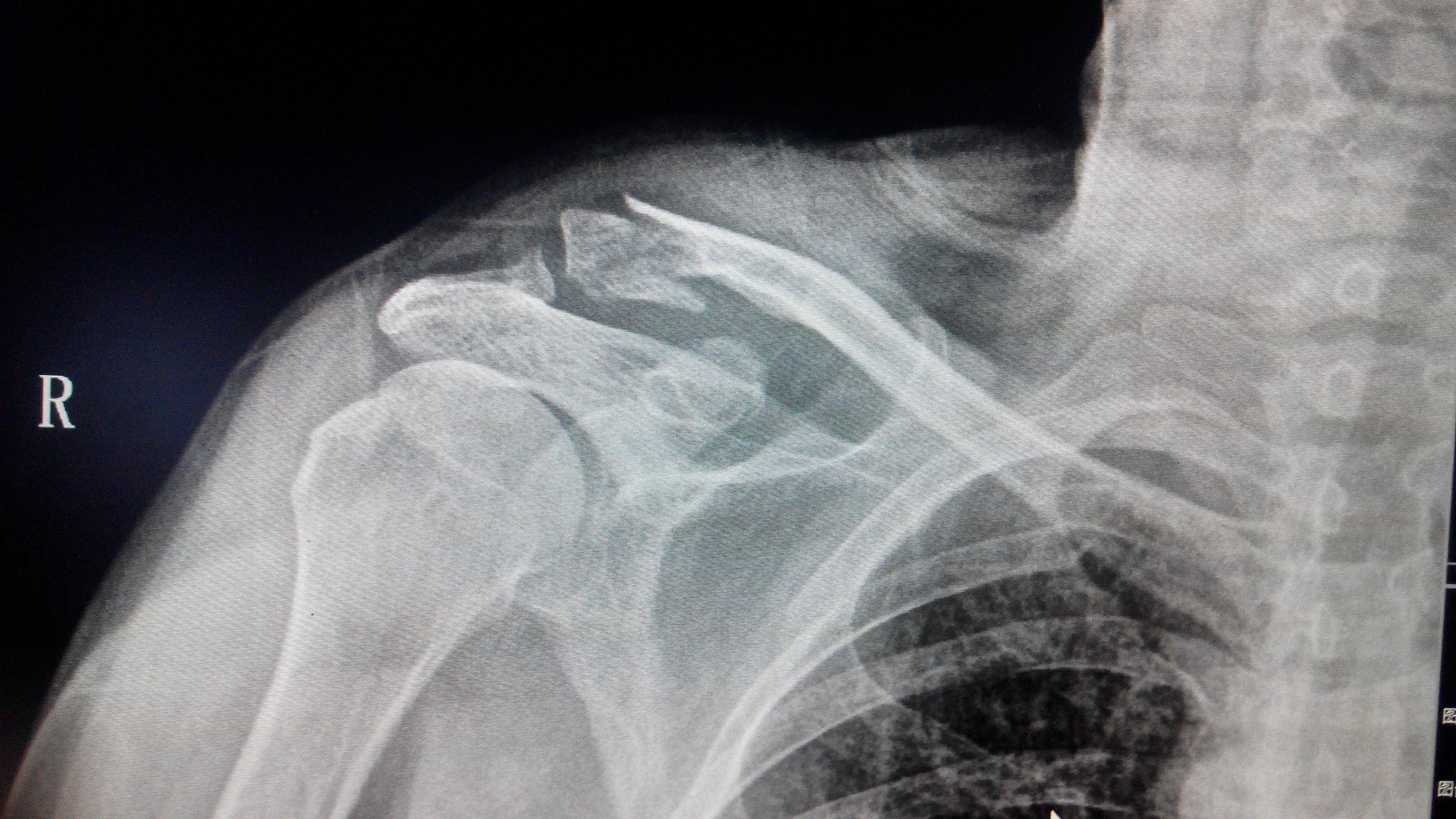 锁骨肩峰端骨折图片