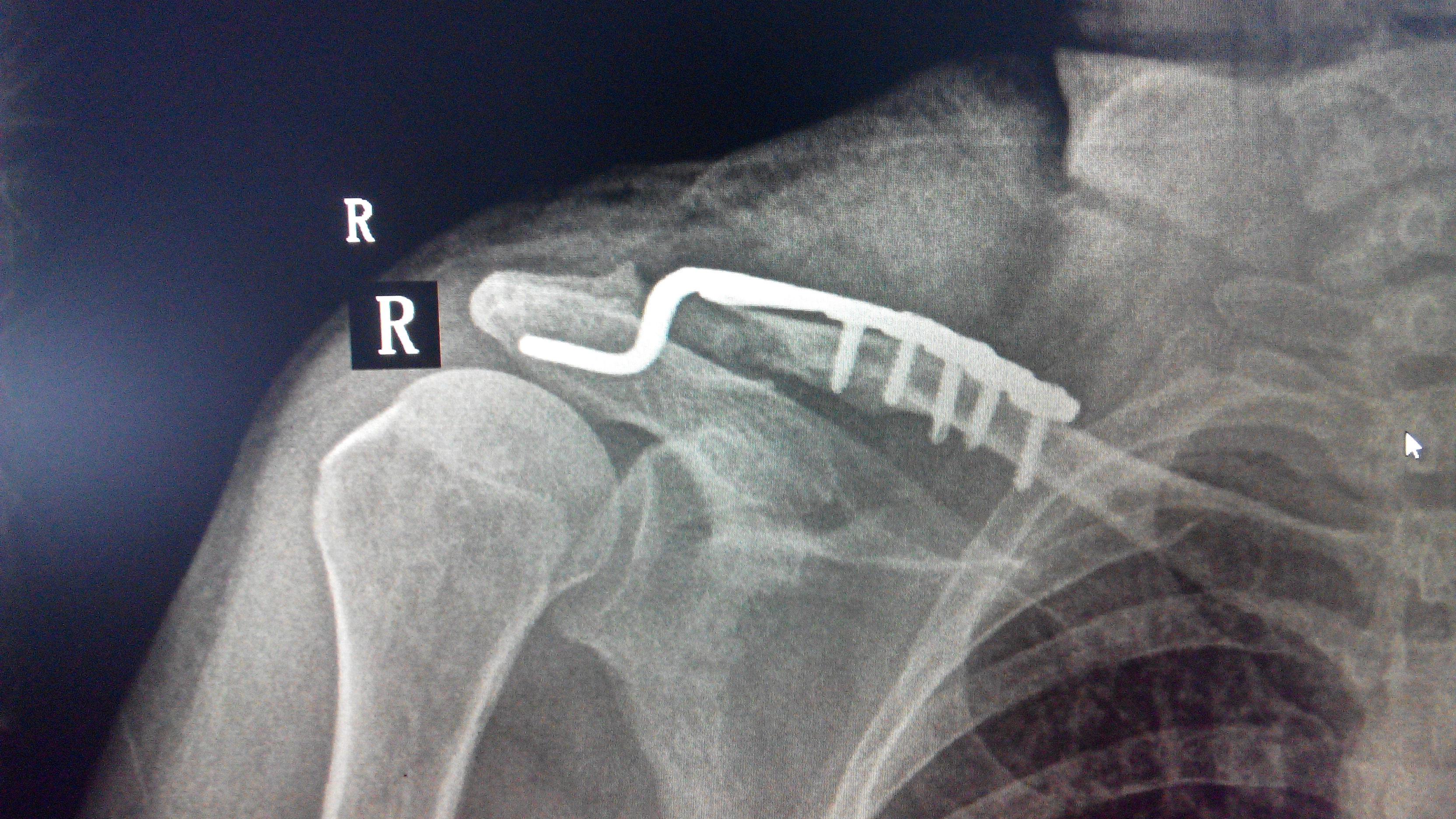 锁骨骨折用的钢板图片图片
