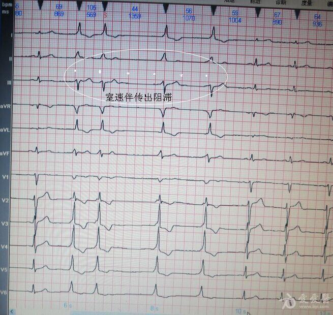 宽大的qrs波的心电图图片