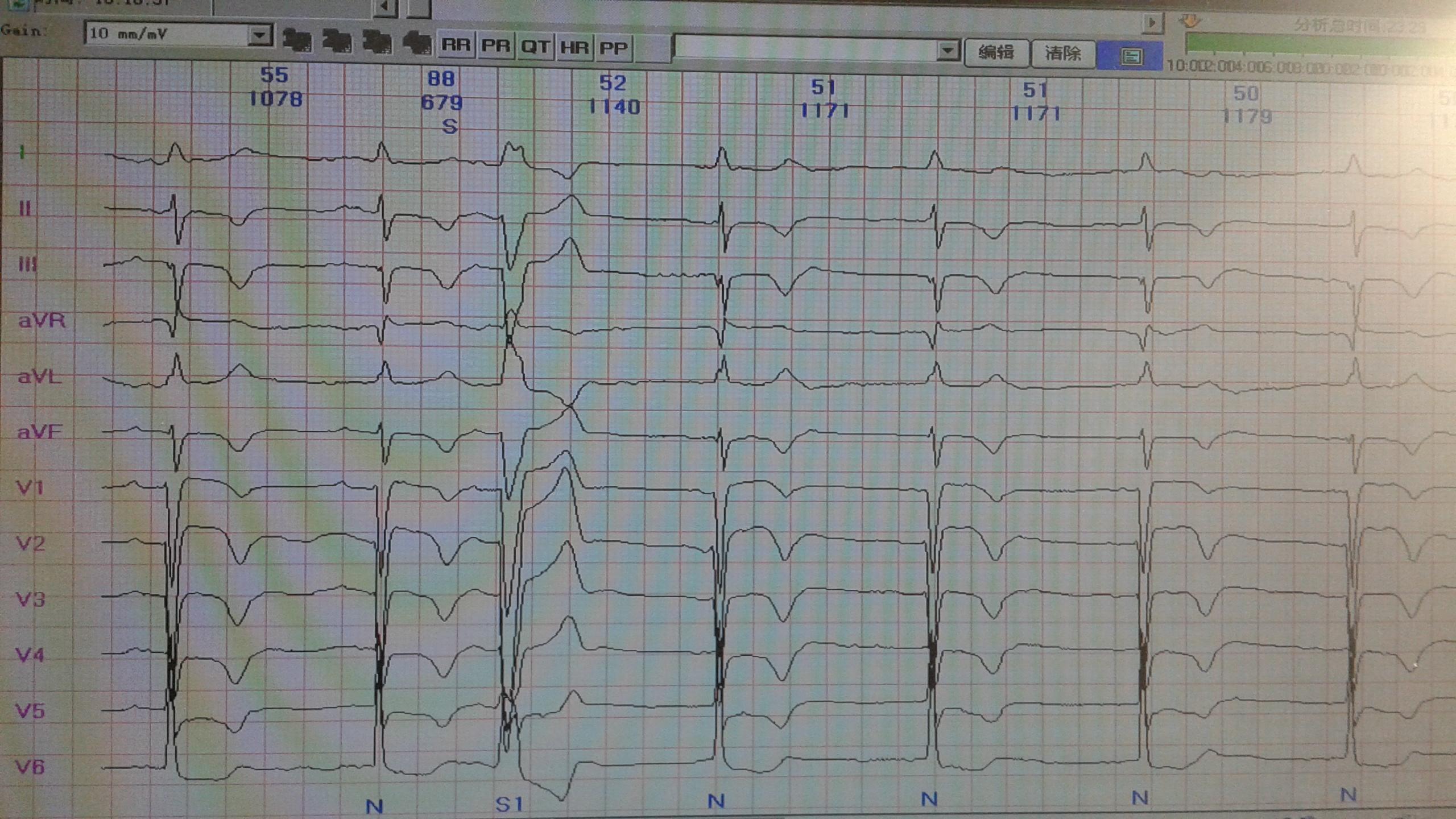 臨床檢查區 69 心電圖腦電圖專業討論版 69 是間隙性完左,房早