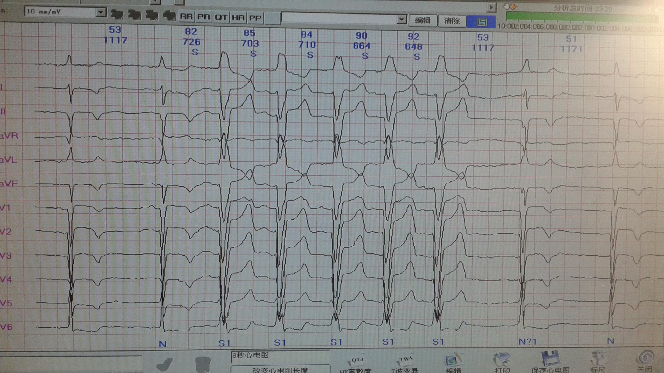 69 心电图脑电图专业讨论版 69 是间隙性完左,房早伴差传,室早?