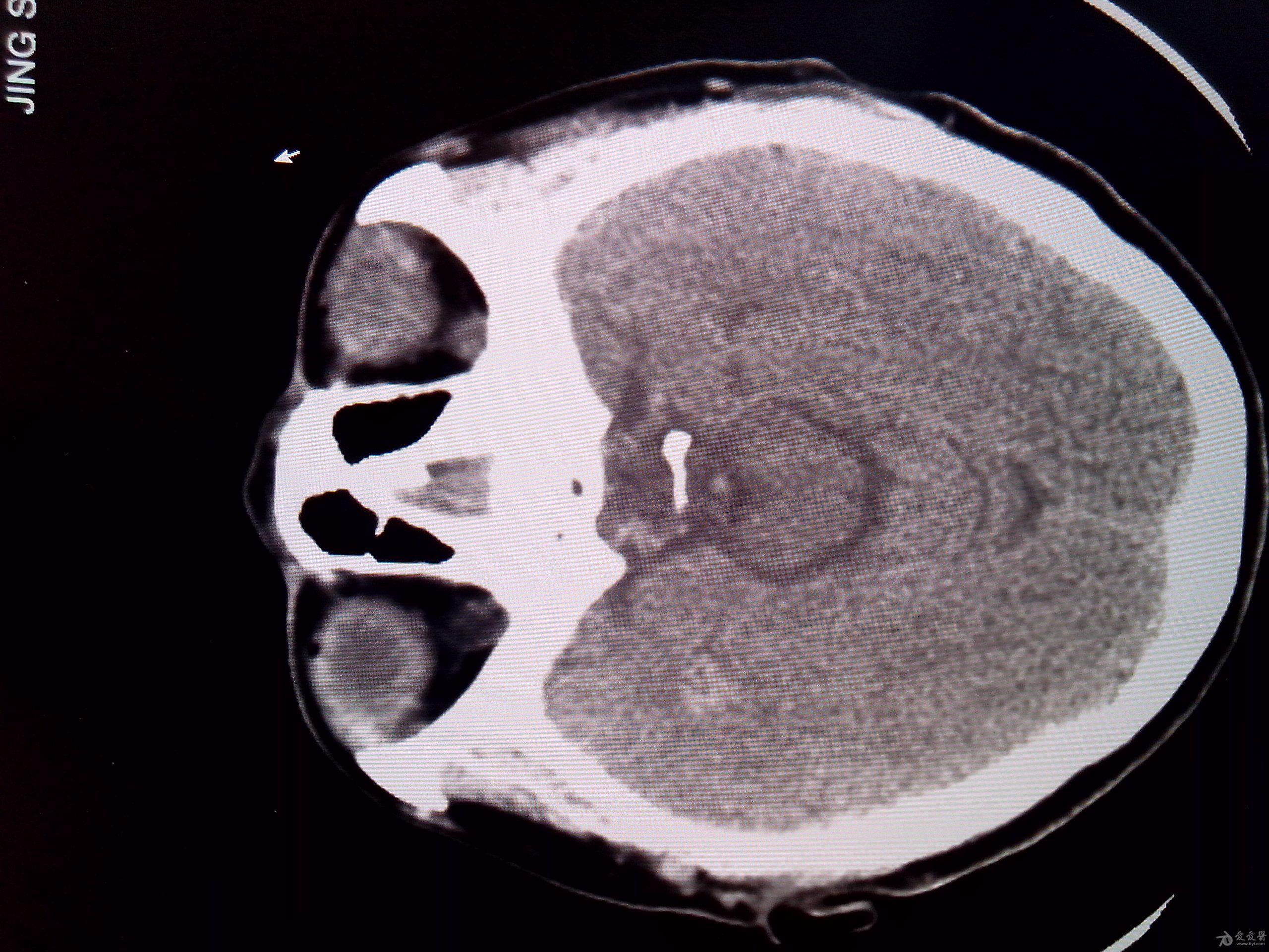大脑颞叶高密度 - 医学影像学讨论版 - 爱爱医医学论坛