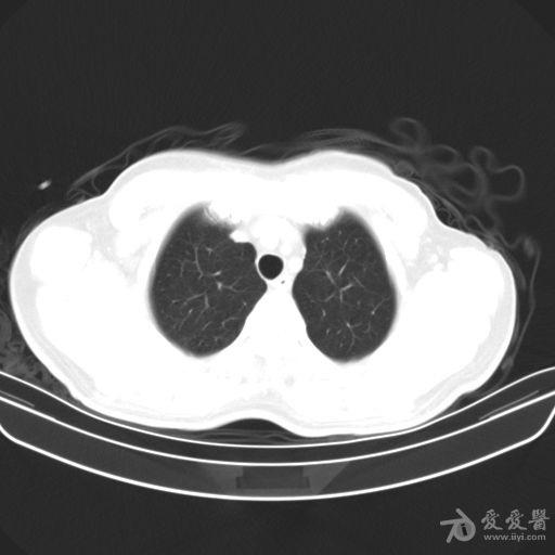 男性患者,55岁,头晕头痛4个月,近日加重.