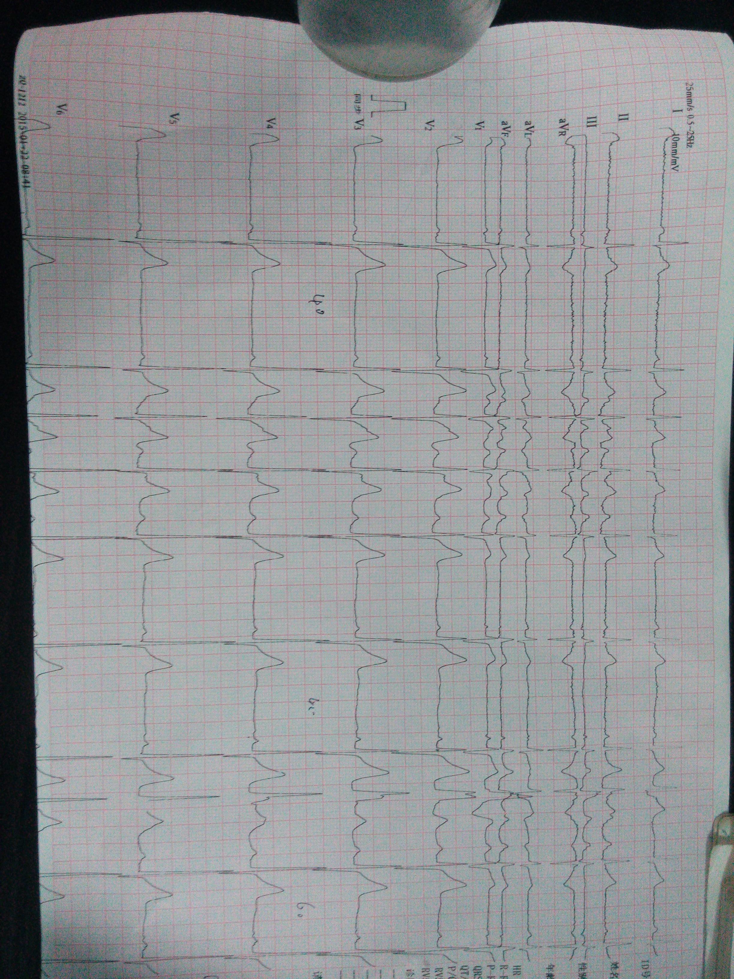 窦缓,心律不齐,短阵房速,室内差传 