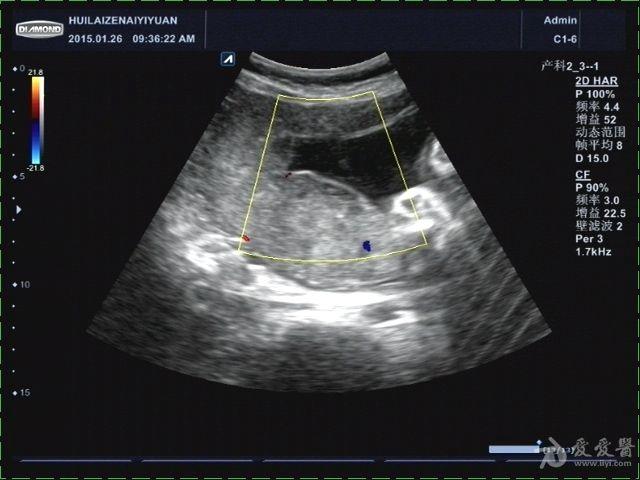 胎盘分级超声图片图片