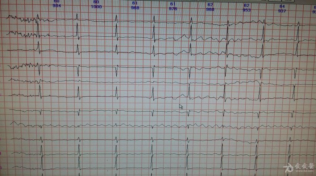 老師們來看看啊動態心電圖到底是干擾還是房撲