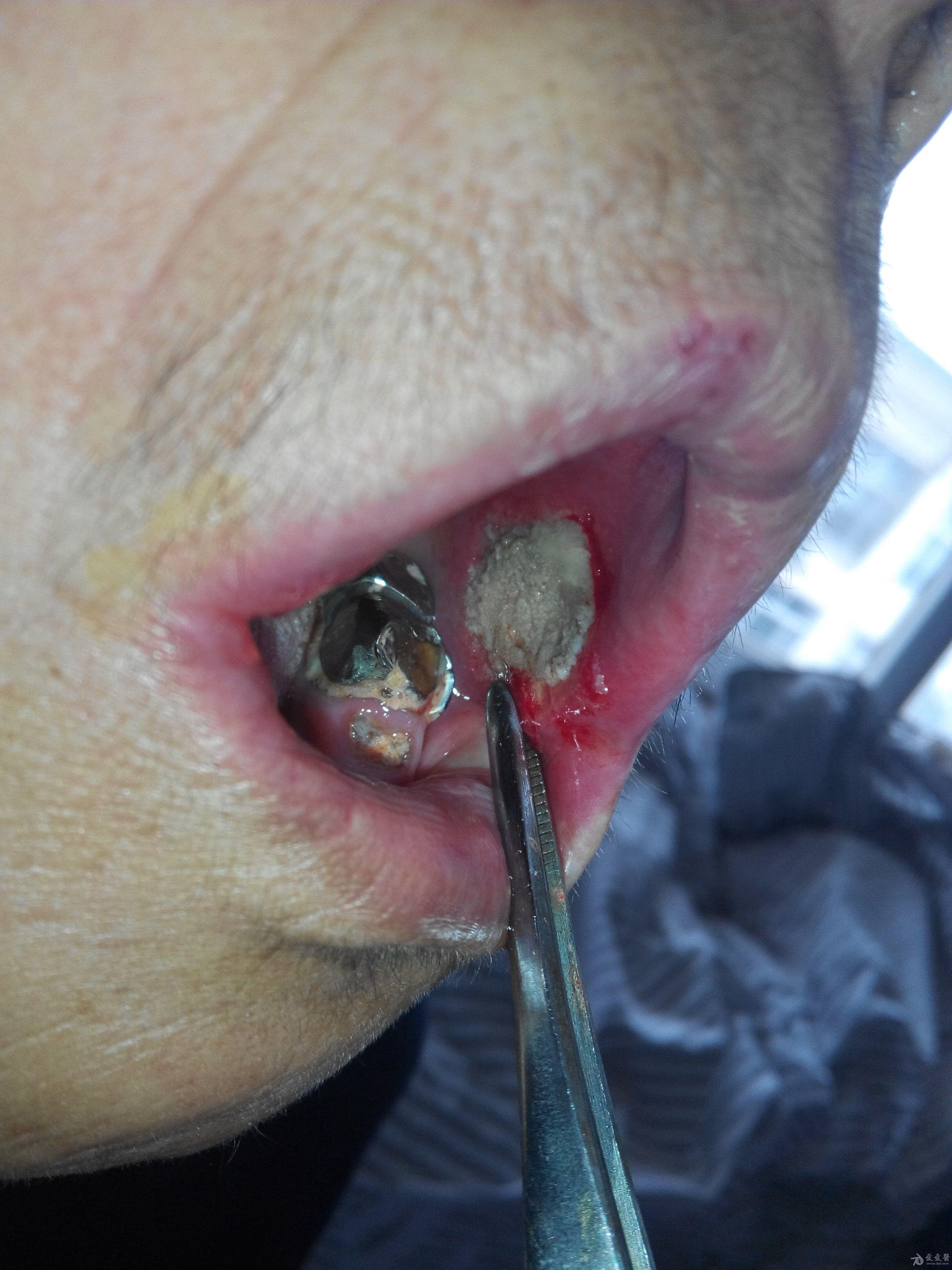 口腔溃疡最严重的图片图片