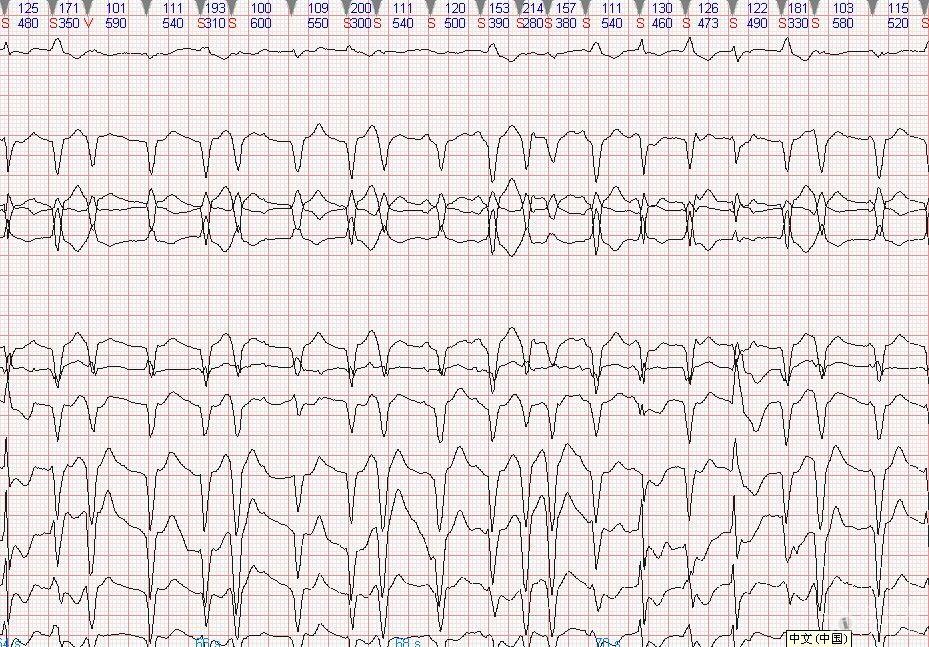 请各位老师看看这份心室停搏29s的心电图,麻烦老师给分析指导!