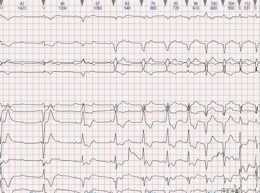请各位老师看看这份心室停搏29s的心电图,麻烦老师给分析指导!