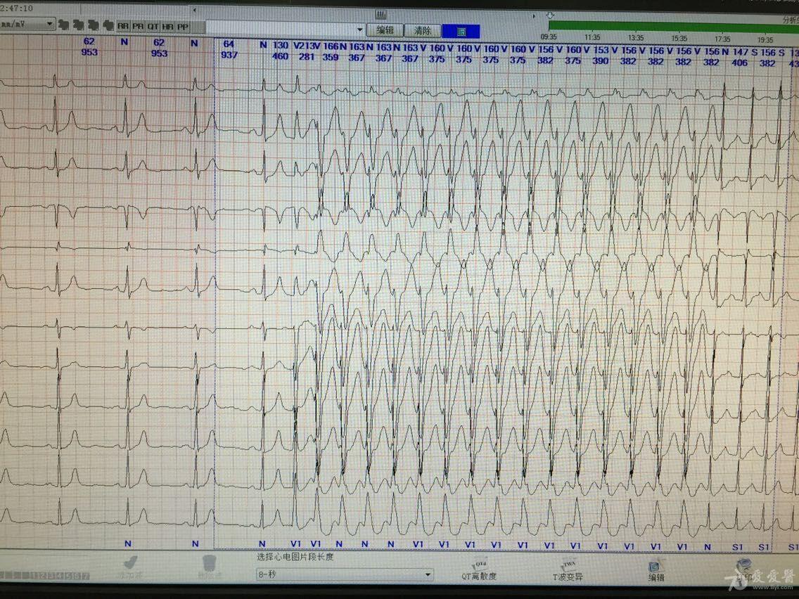 寬qrs室上速? - 心電圖腦電圖專業討論版 - 愛愛醫醫學論壇
