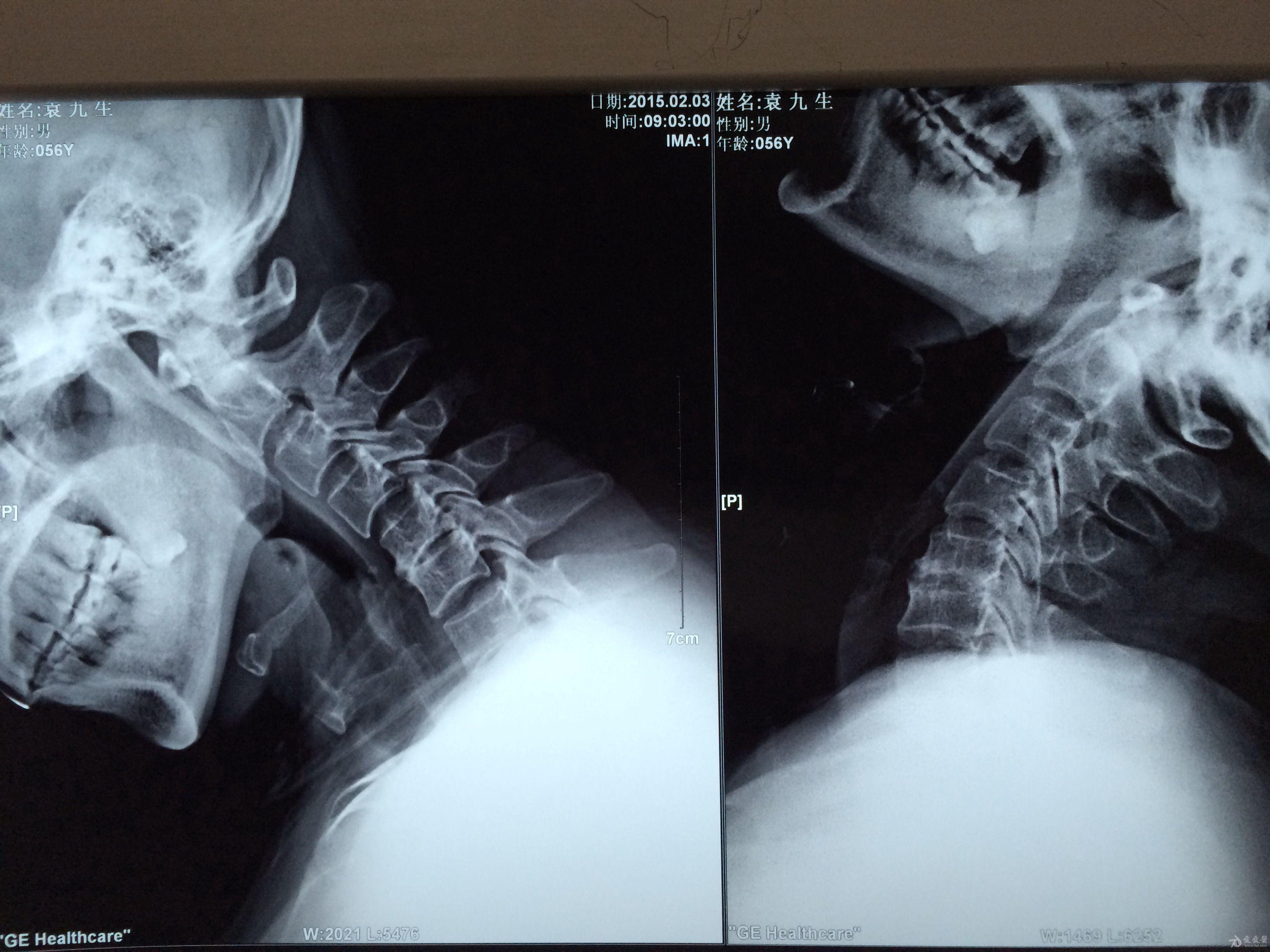 肌萎缩型颈椎病