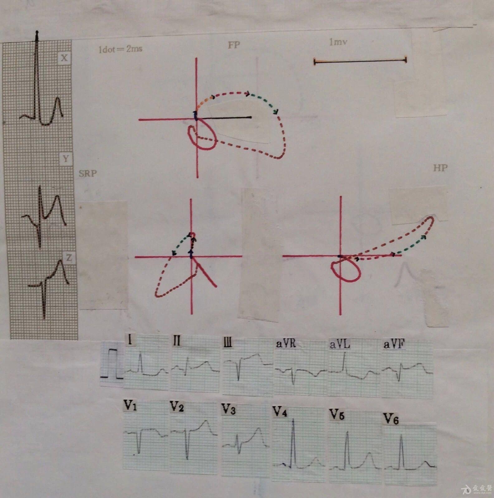 迎新年看心电图熟悉向量图图44仅有下壁心肌梗死吗