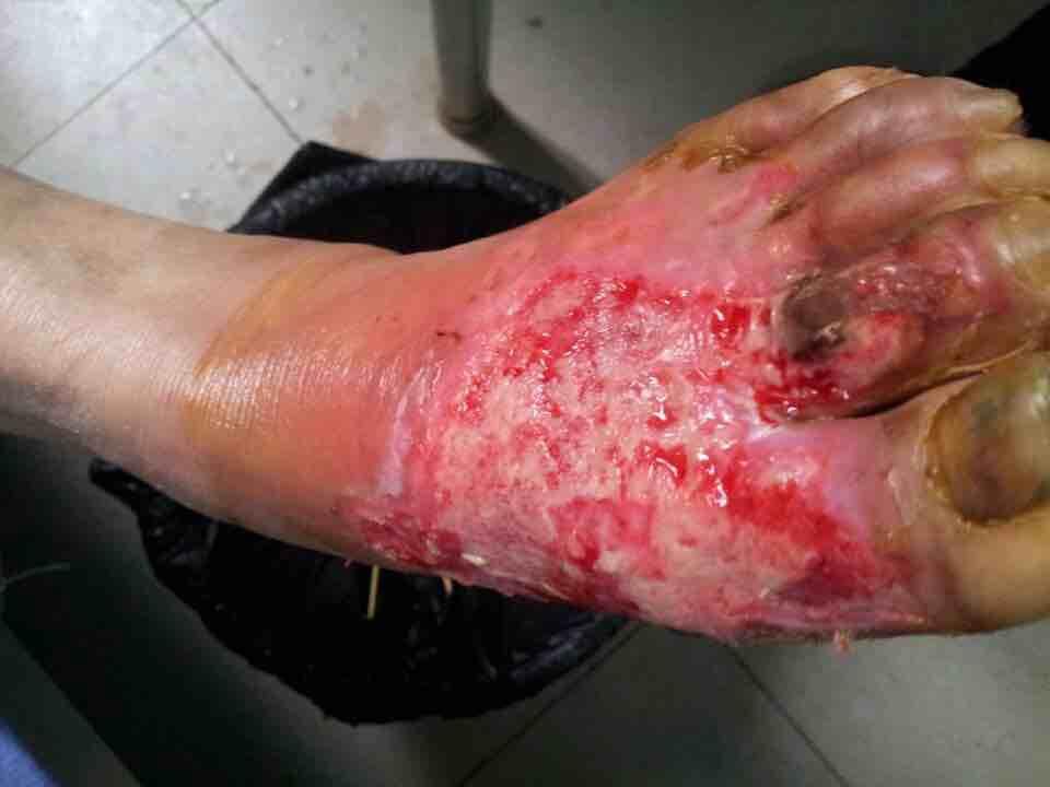 糖尿病烫伤病例求教