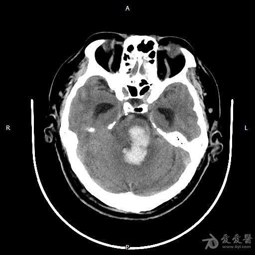 脑干出血11天求围观