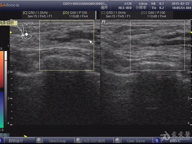 双乳乳腺导管扩张