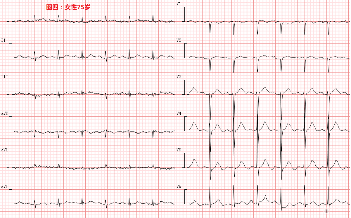 图四女性75岁-u波倒置?png