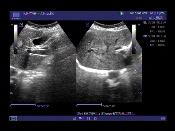 胆管癌超声图片