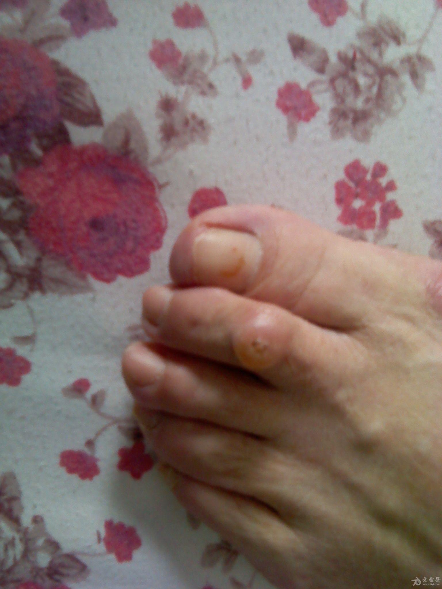 足肌腱炎的症状图片图片