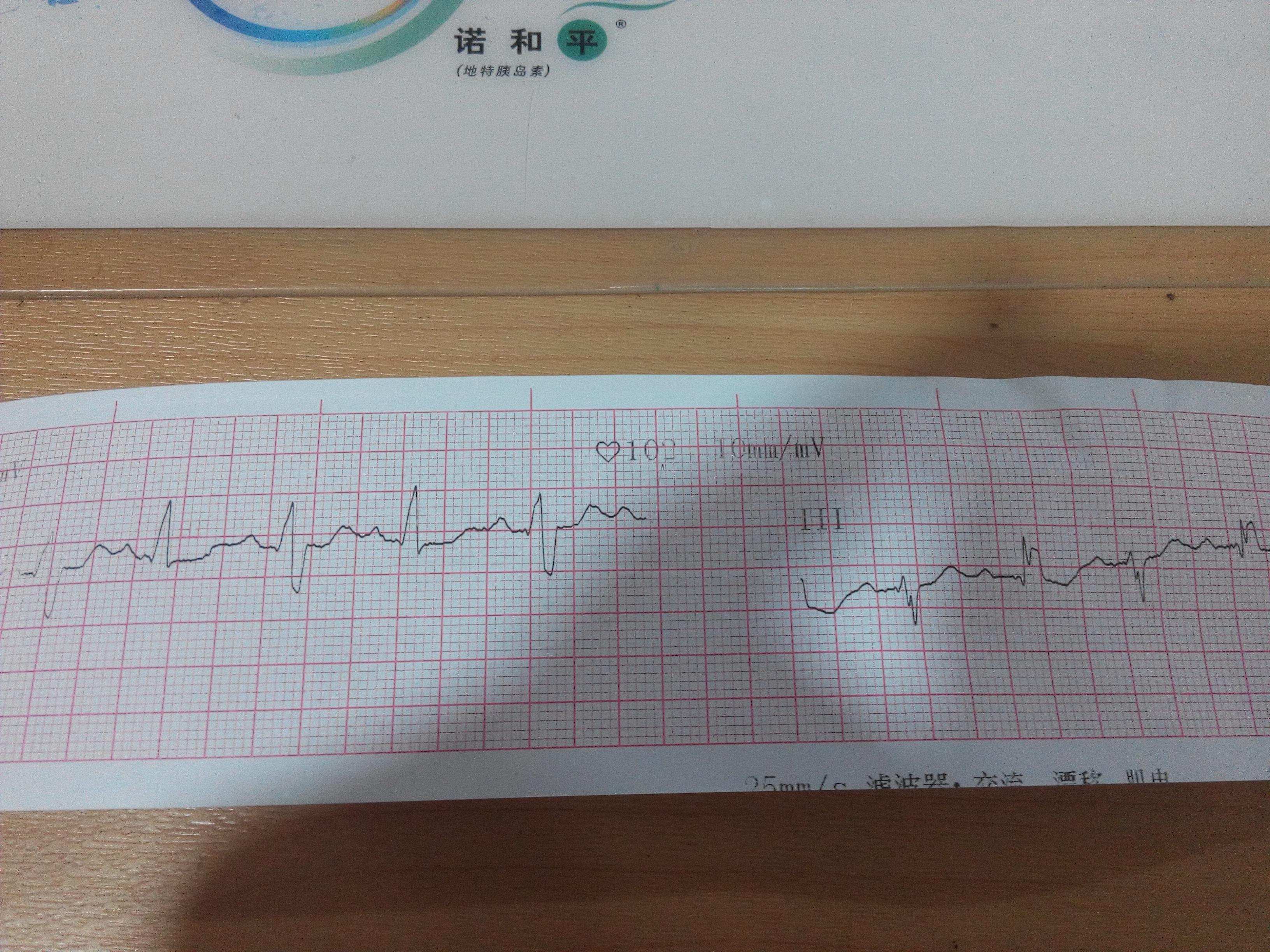 是不是室早二联律?求鉴定 