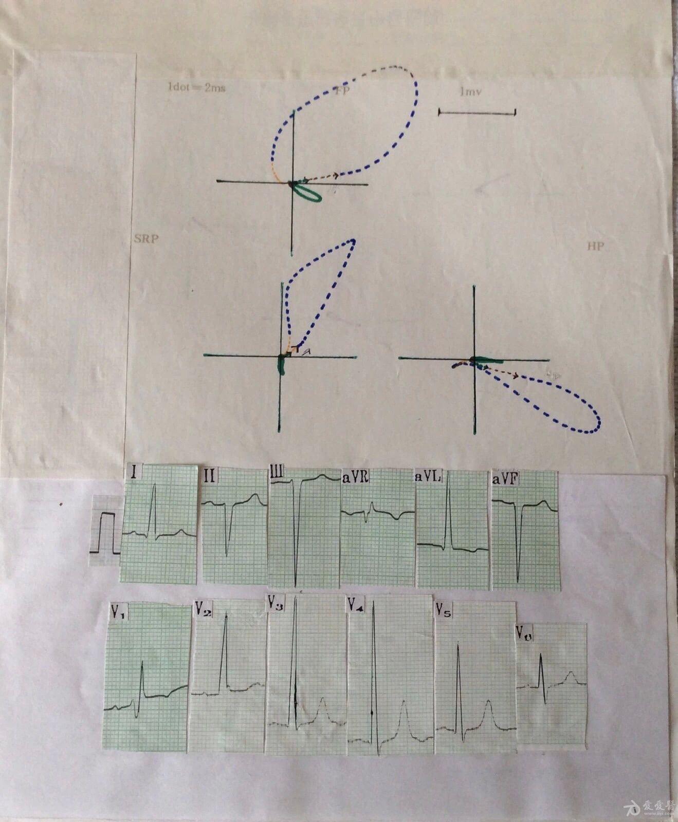 心电图电轴偏向图片