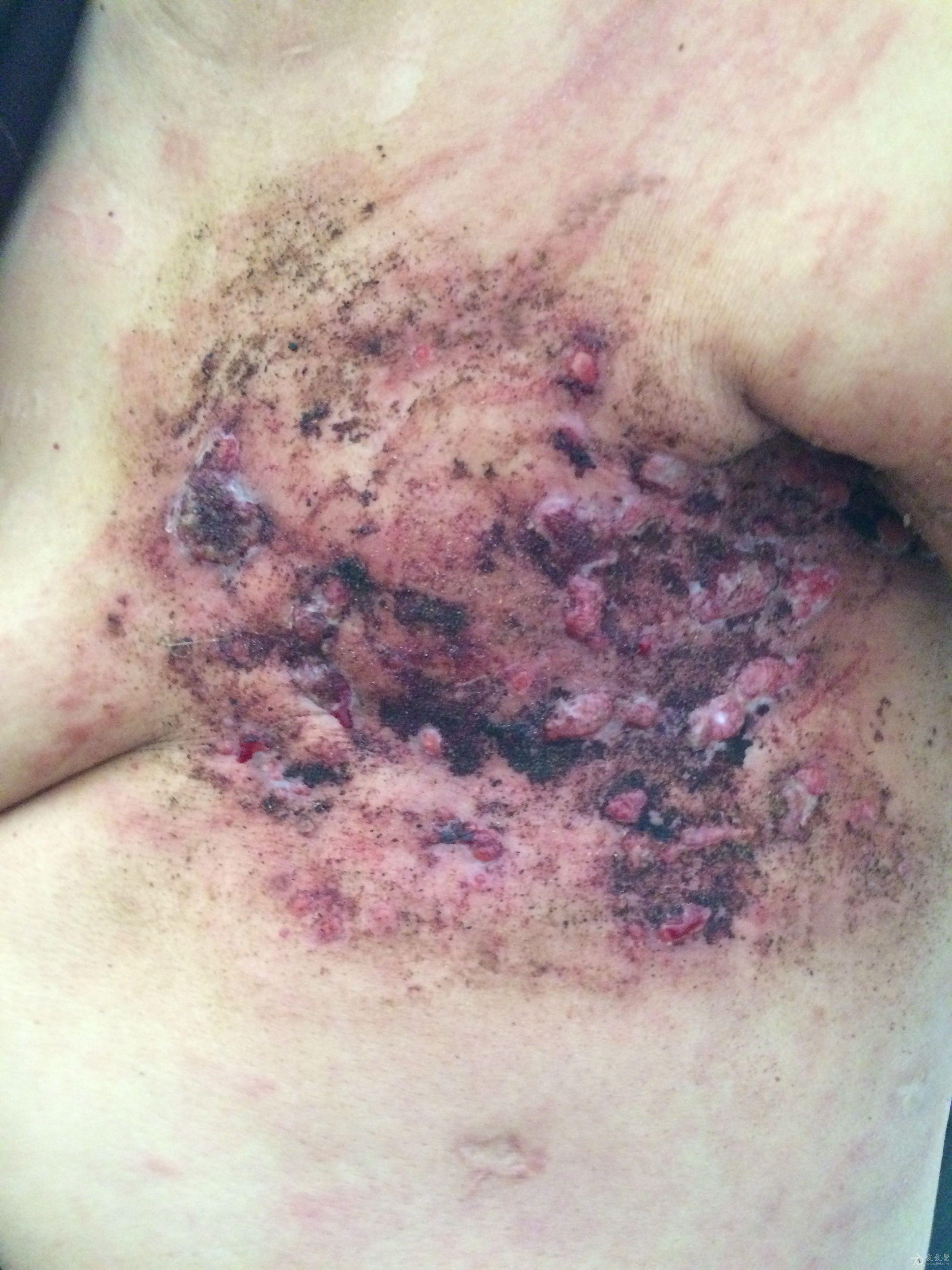 乳腺癌红肿溃烂的图片图片