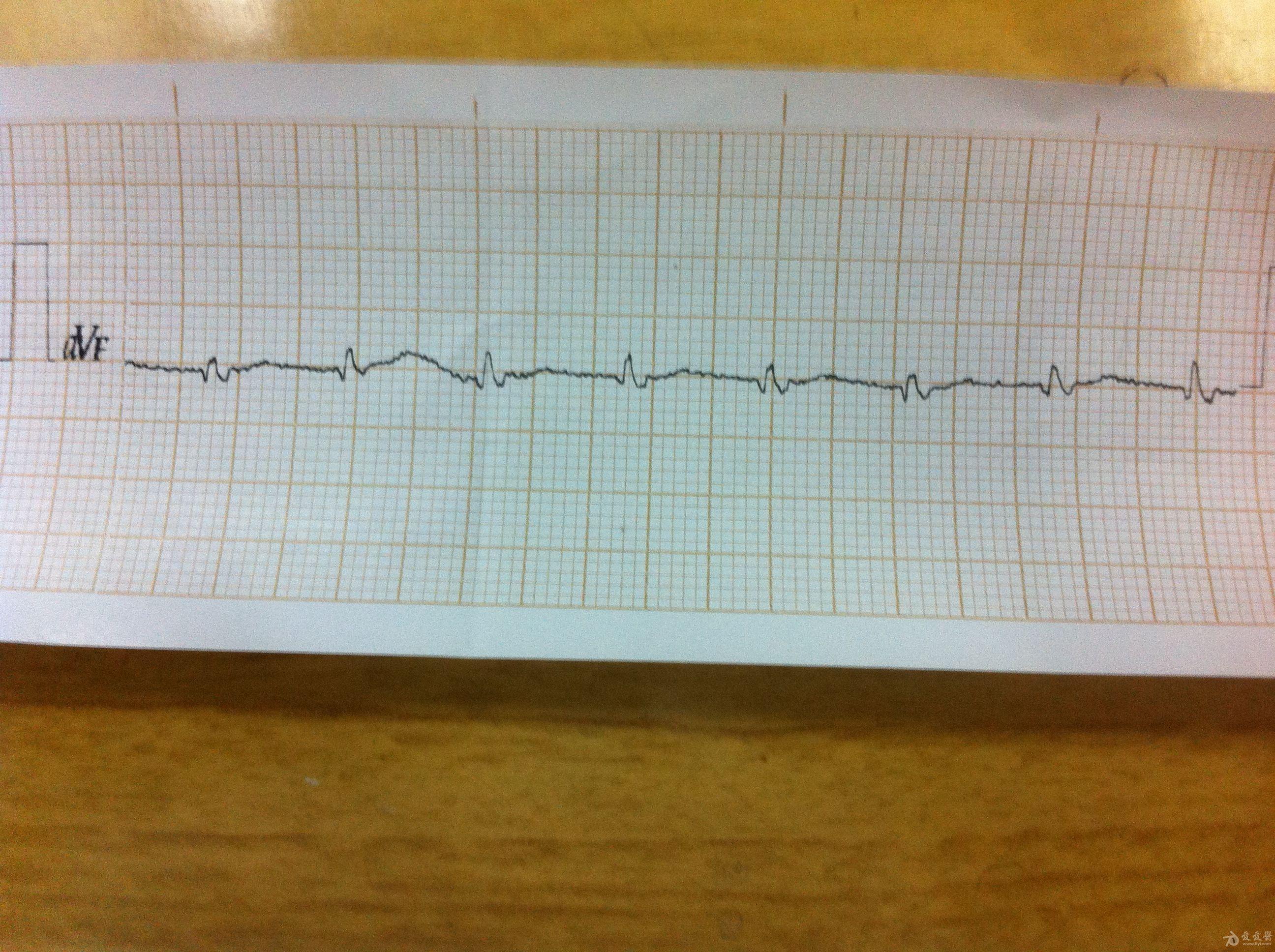 求教心电图这份心电图p波看不到