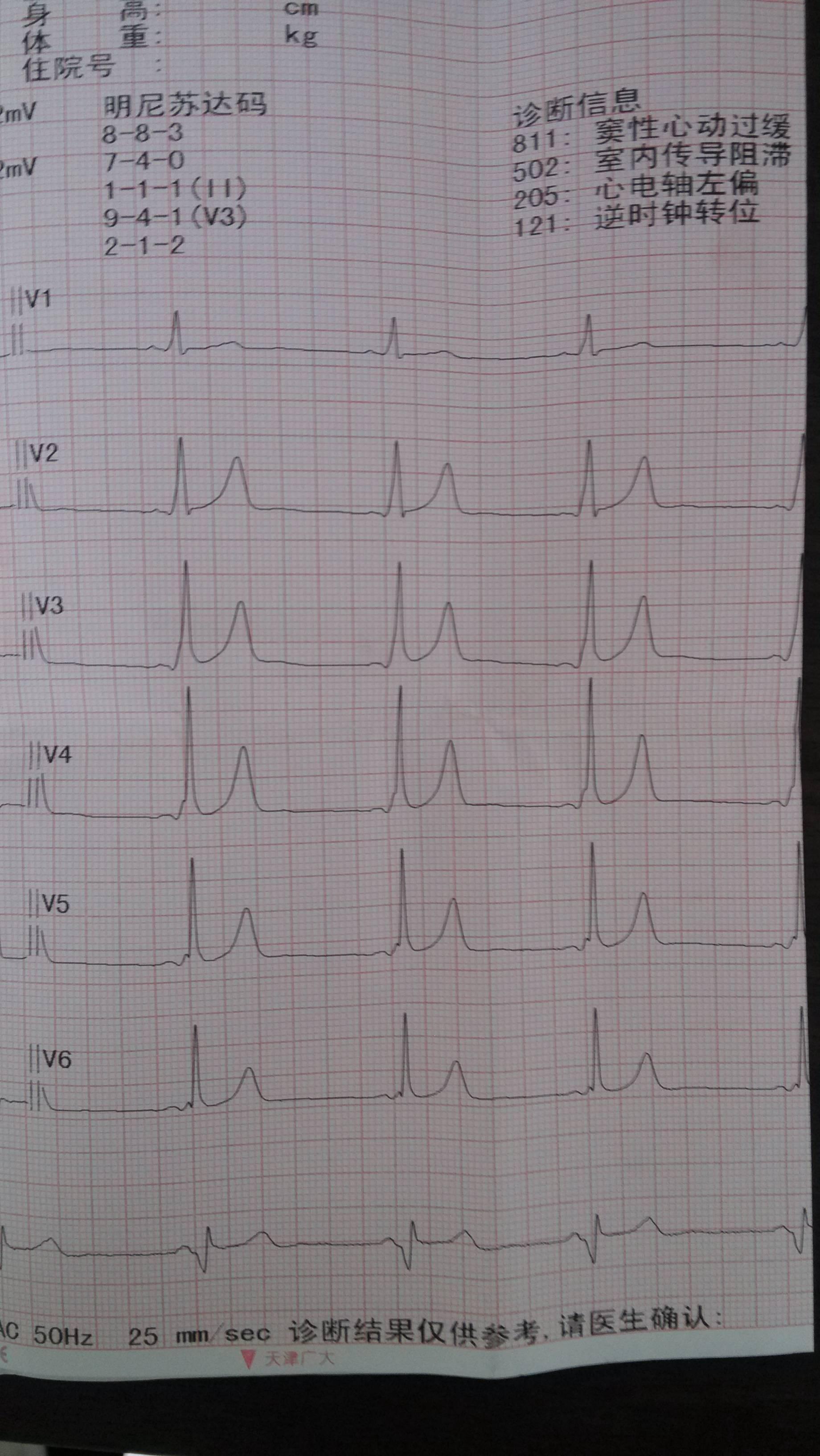 乡级医院请各位老师帮忙看个心电图