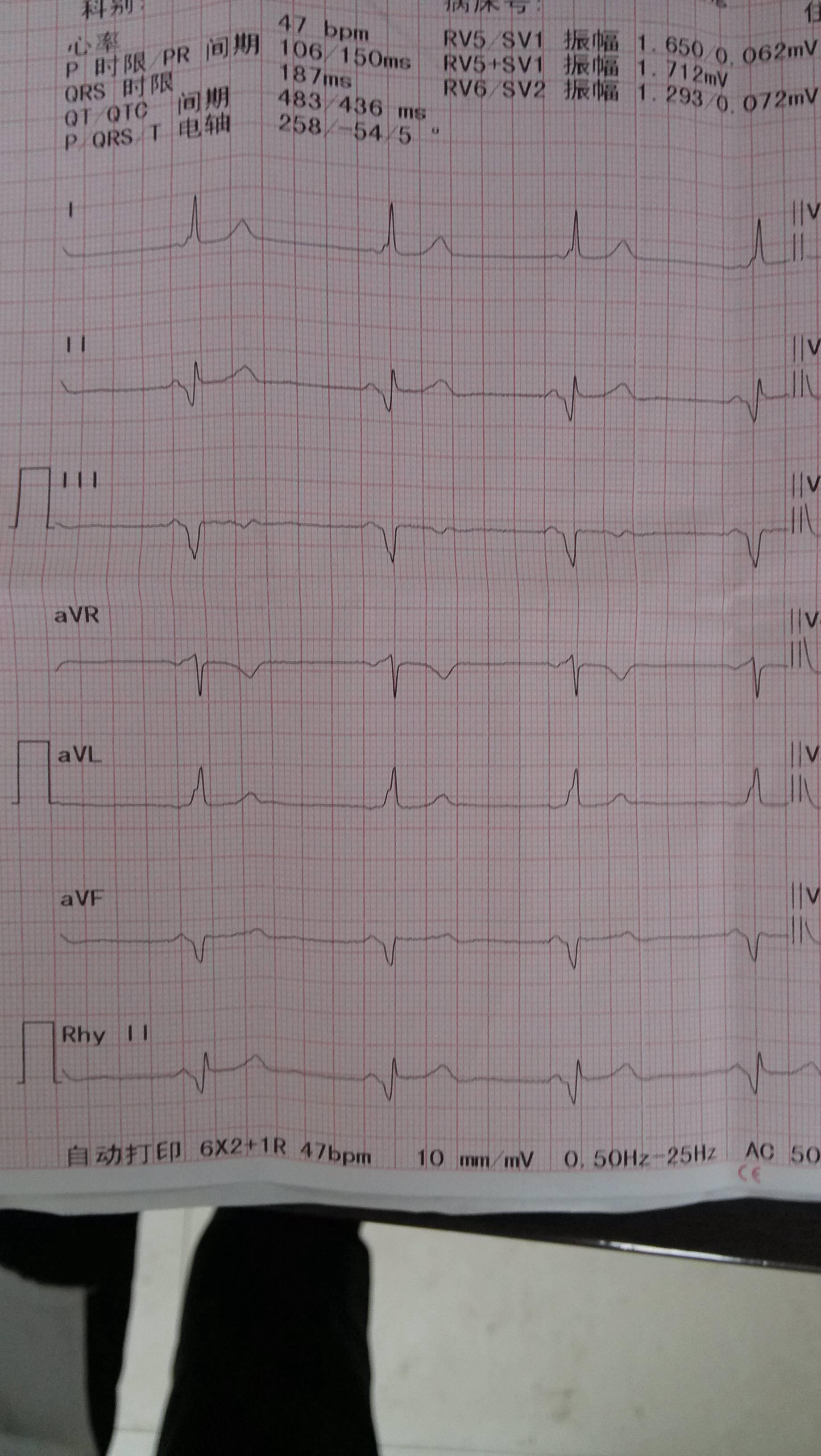 乡级医院请各位老师帮忙看个心电图