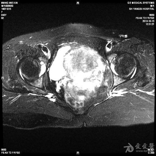 盆腔巨大囊性崎胎瘤mri