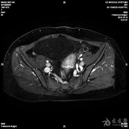 盆腔巨大囊性崎胎瘤mri