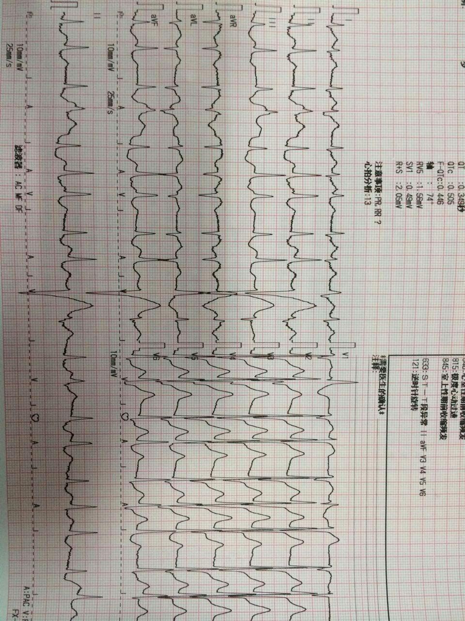 看這份心電圖者心慌胸悶