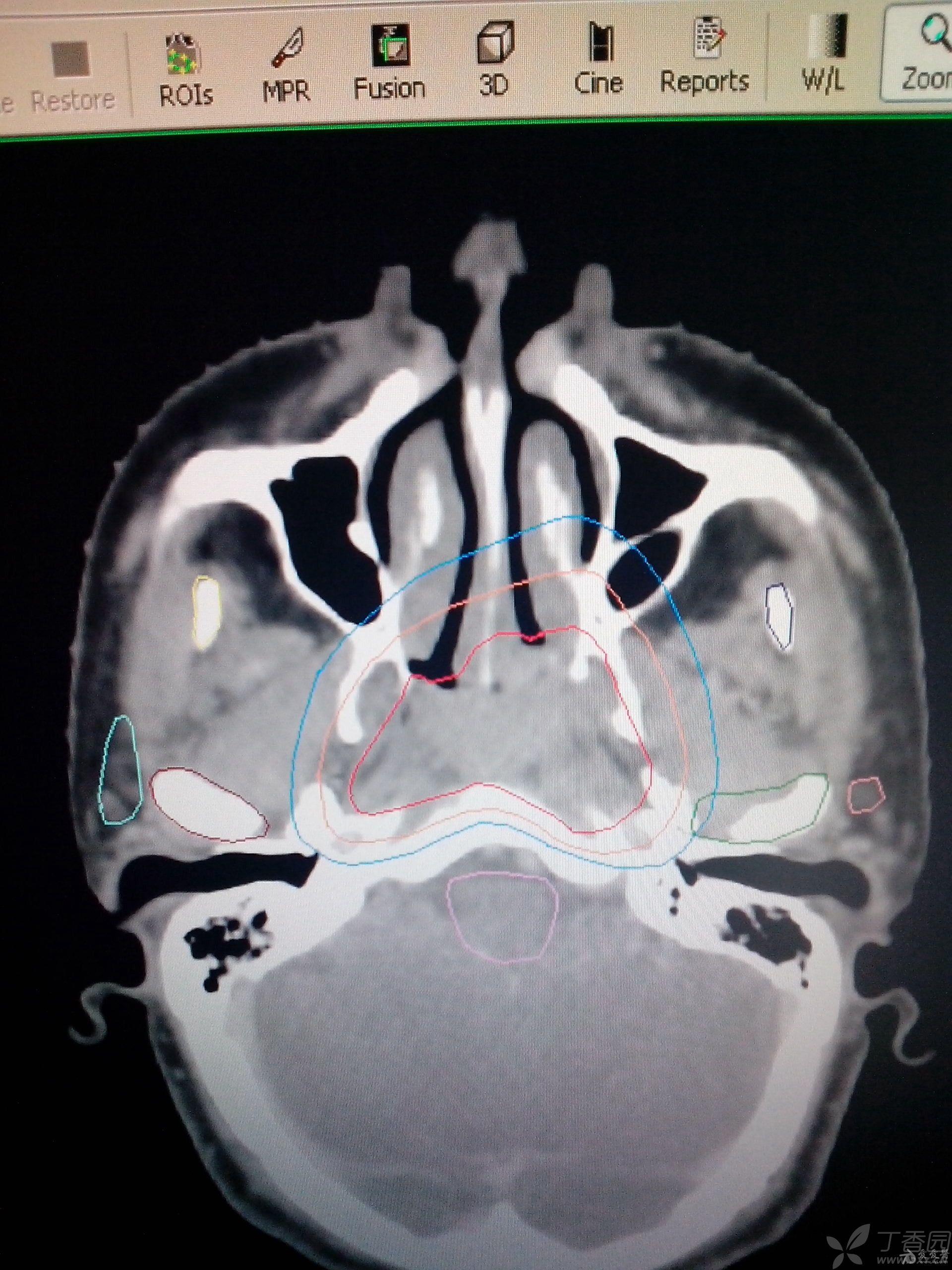 鼻咽癌靶区勾画的上界
