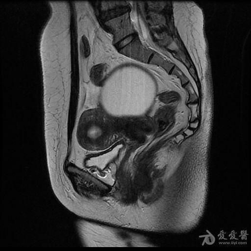 女性做磁共振要脱内衣