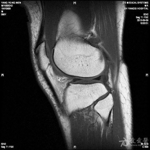 膝盖滑膜炎的治疗周期一般是多久 150323122024tnasa0szl6y8xnas.jpg